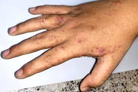 samfya-hit-with-scabies-breakout