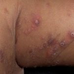 scabies-breaks-out-in-kalabo-district