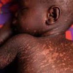 measles-breaks-out-in-eastern-province