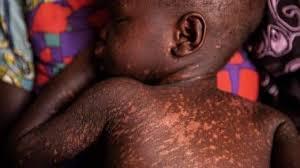 measles-breaksout-in-chasefu